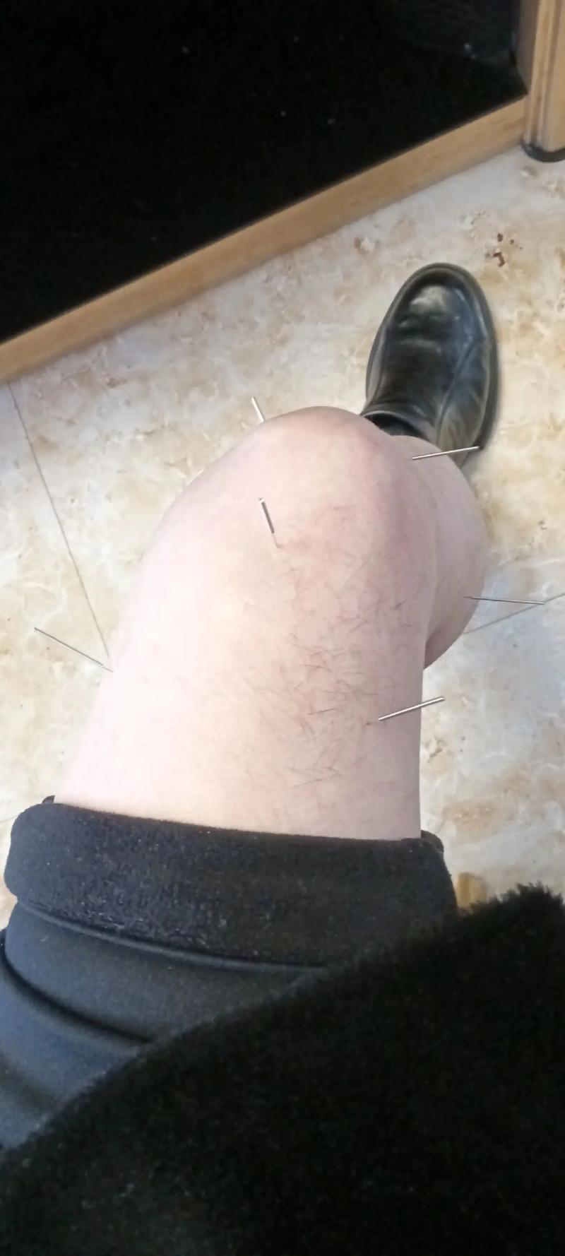 腿疼针灸三次就不疼了