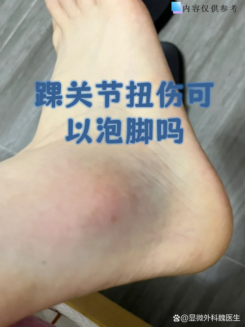 脚踝内侧肿痛是痛风吗