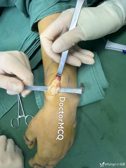 痛风石手术挂什么科室