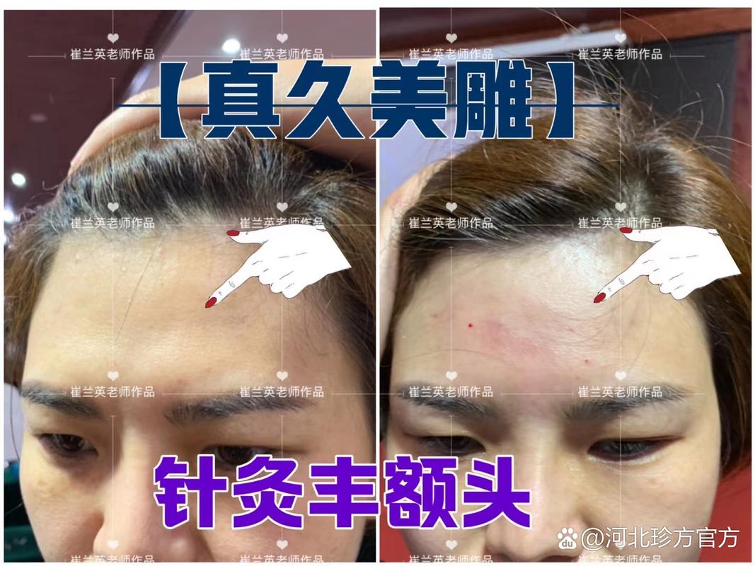 针灸美雕谁做过可靠吗