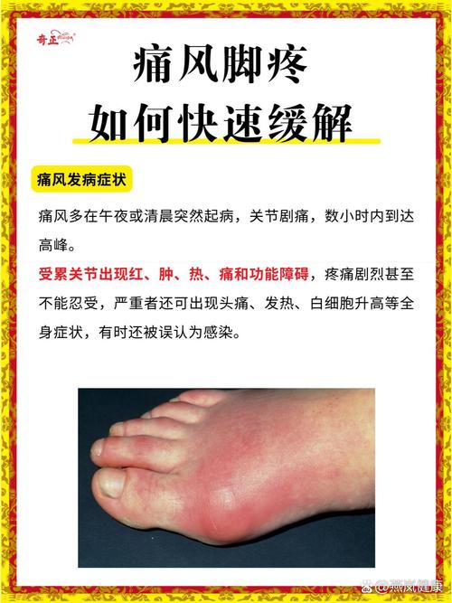 痛风脚踝肿痛怎么缓解