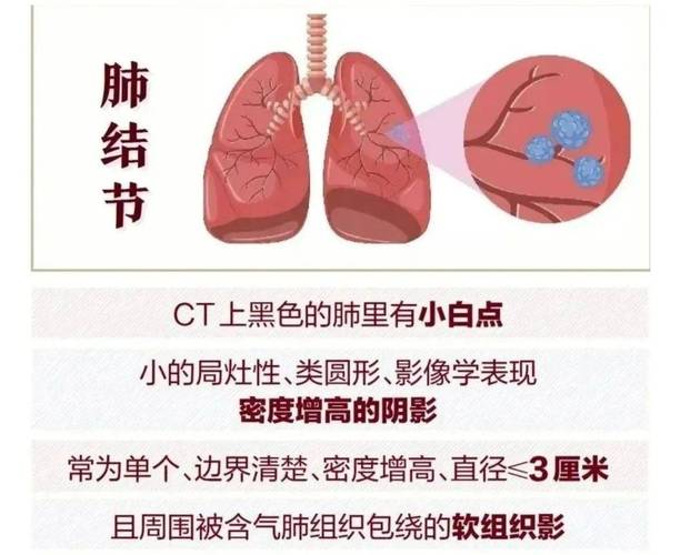 肺结节长在哪里最安全
