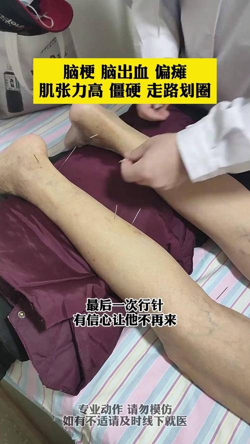 针灸治疗脑梗塞后遗症