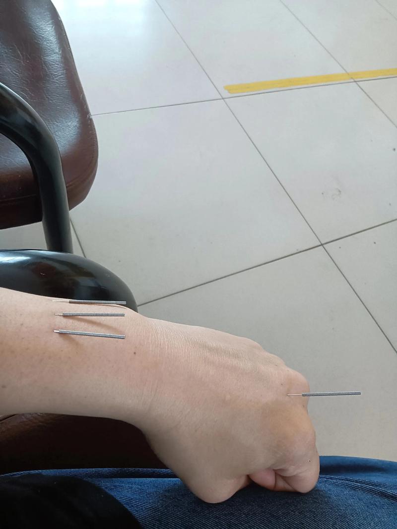 脑梗塞后遗症针灸治疗