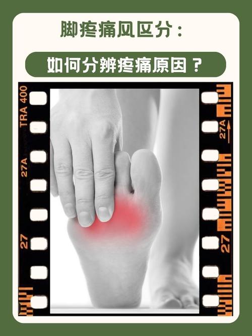 痛风和风湿是一回事吗