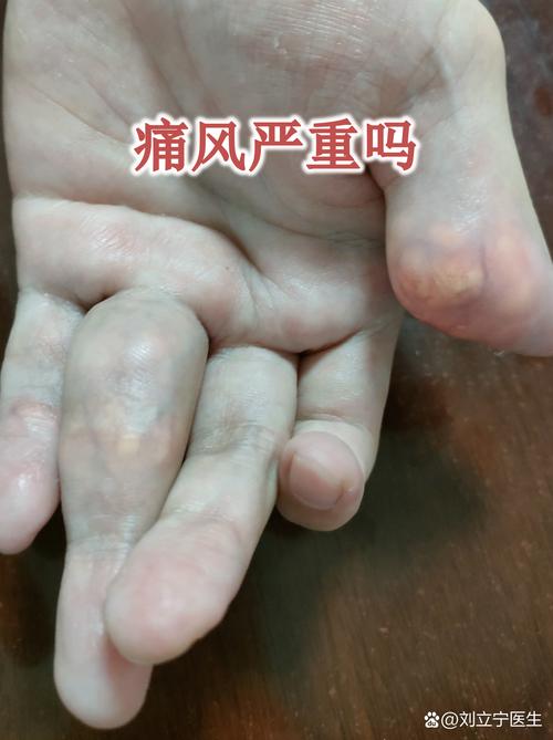一旦痛风就得一辈子吗