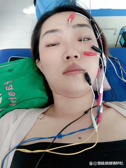 面神经麻痹的针灸治疗