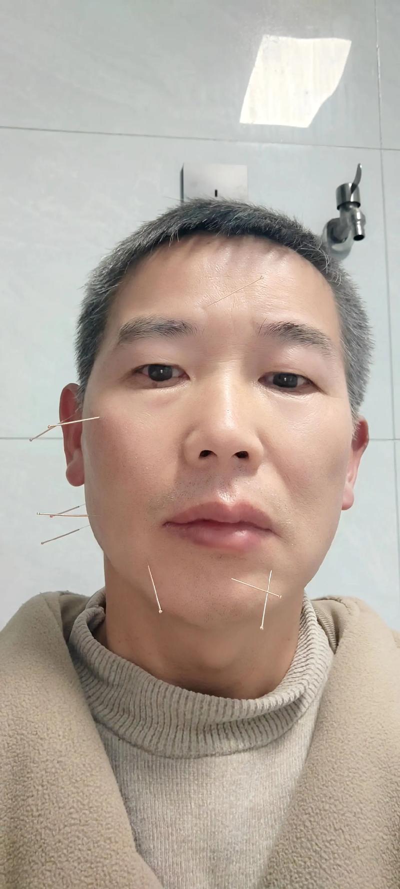 针灸治疗面瘫多久见效