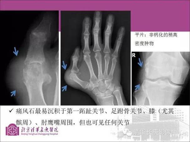 痛风拍片子能看出来吗