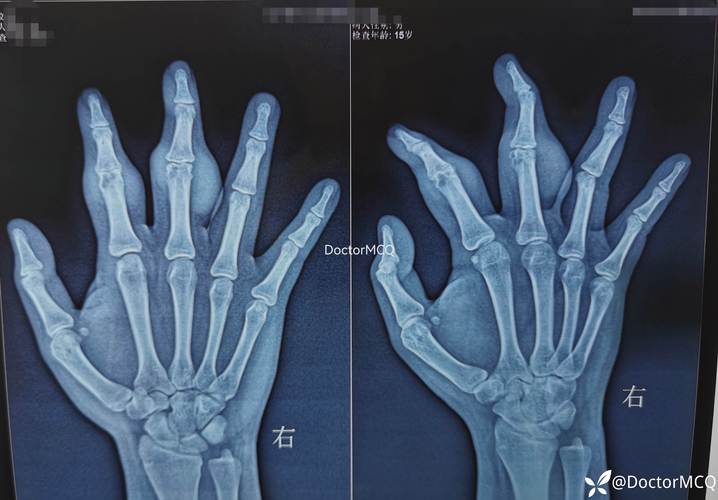 痛风拍片子能看出来吗