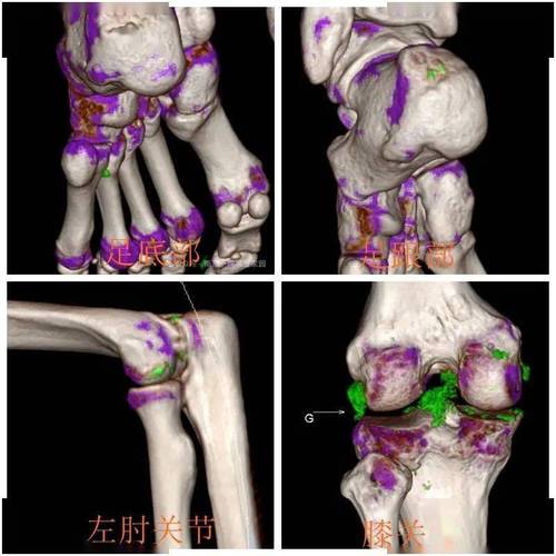 痛风拍片子能看出来吗