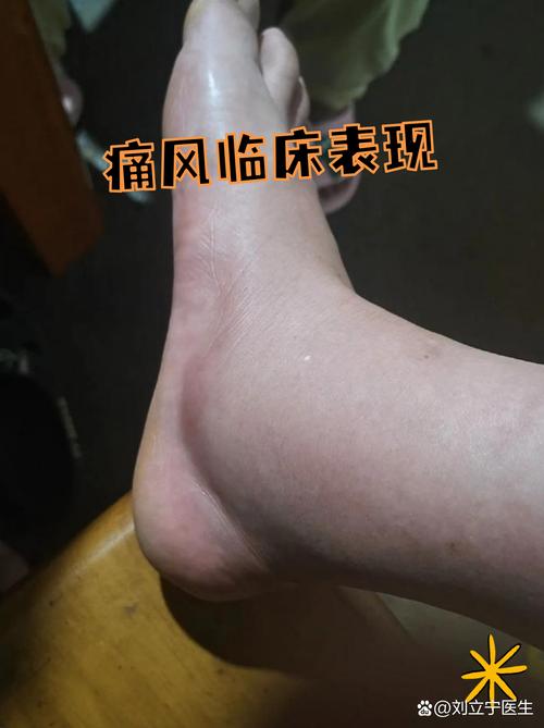 左脚三四脚趾麻是痛风