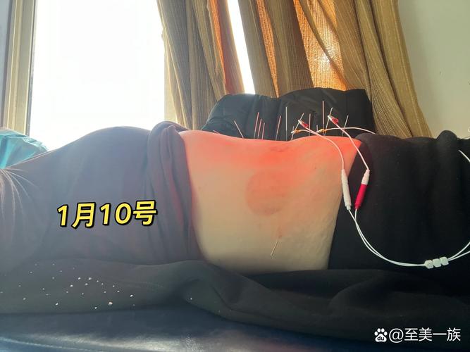 一天最佳针灸减肥时间