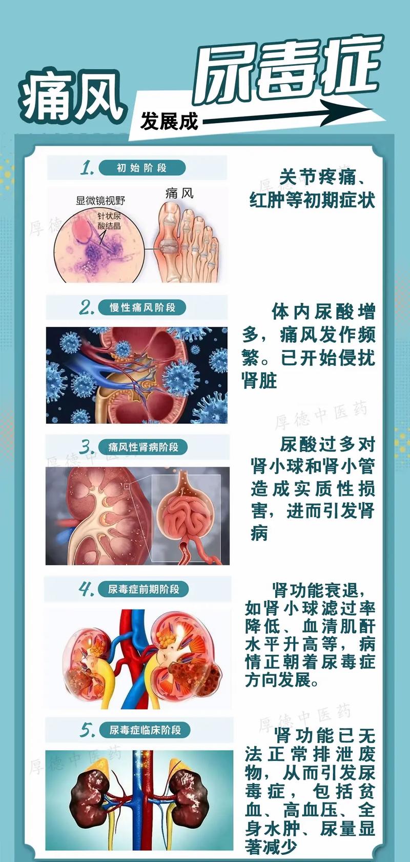 痛风会发展为尿毒症吗
