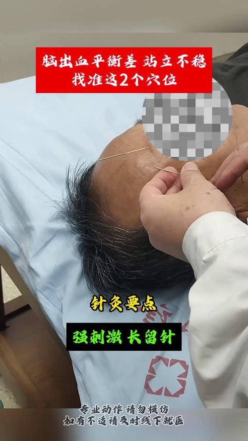 半身不遂针灸视频播放