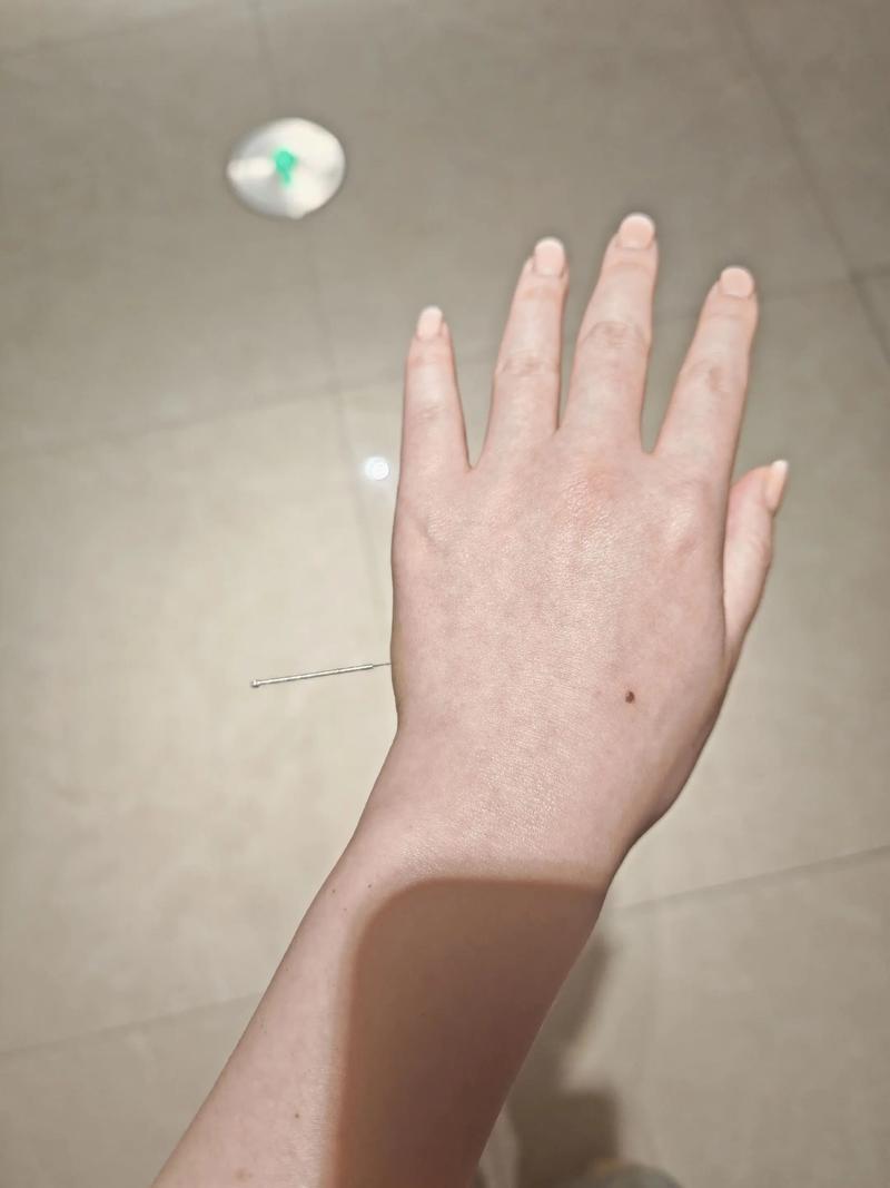 针灸后什么是好转反应