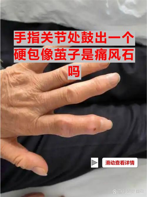 大拇指关节疼是痛风吗
