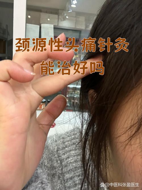 头痛针灸治疗有效果吗