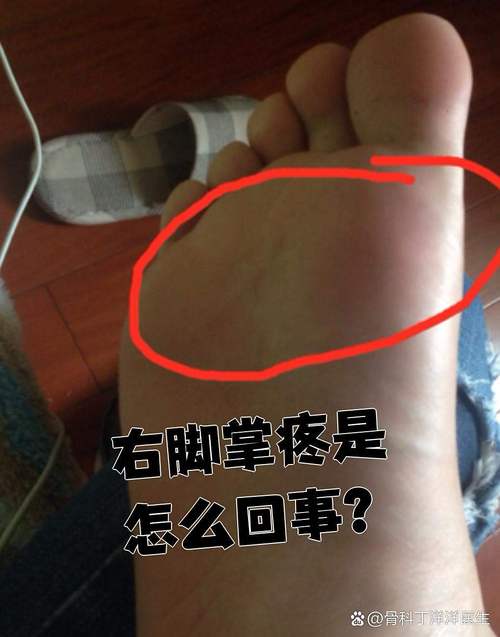 脚底痛是痛风的征兆吗