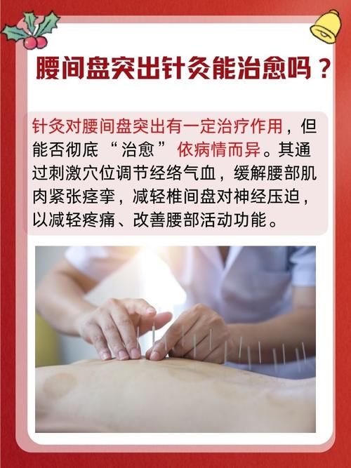 针灸治疗腰间盘突出吗