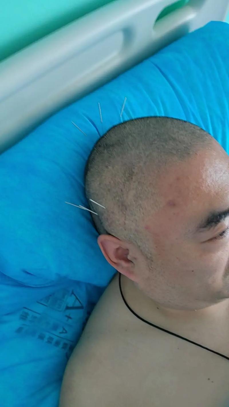 脑供血不足针灸管用吗