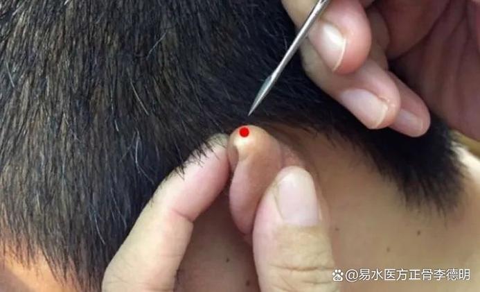 脑供血不足针灸管用吗