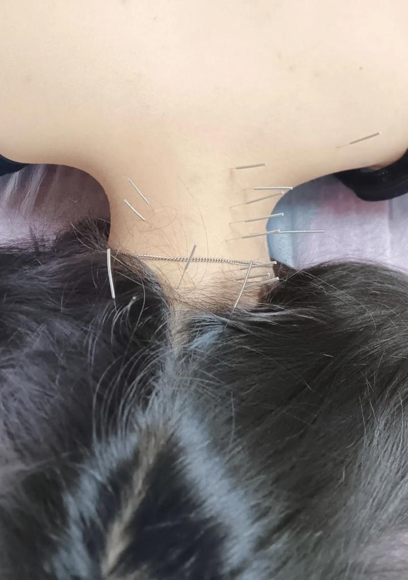 颈椎病脊髓型针灸治疗