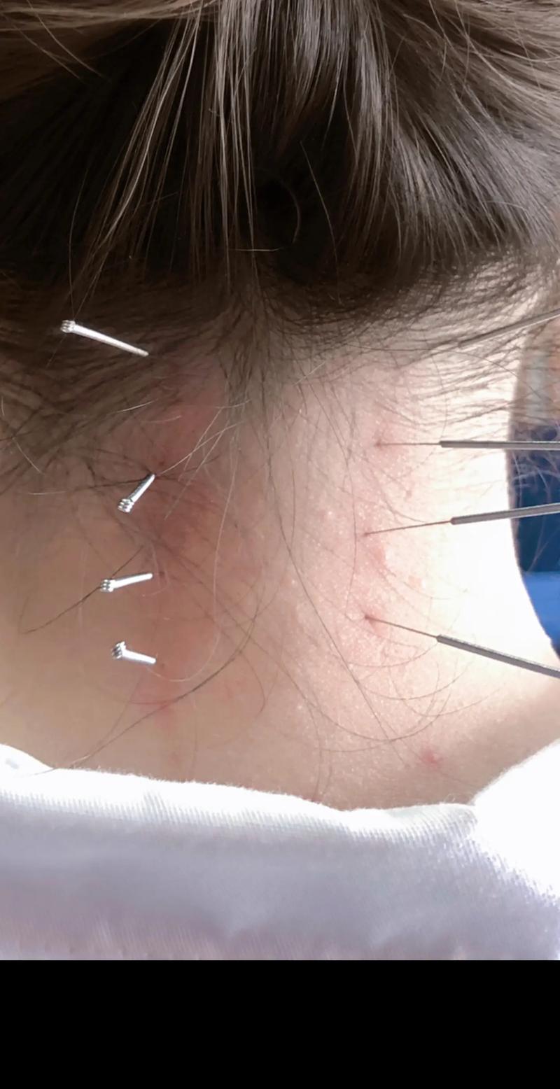 针灸颈椎病有什么作用