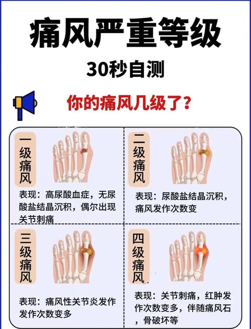 年轻人痛风脚痛怎么办