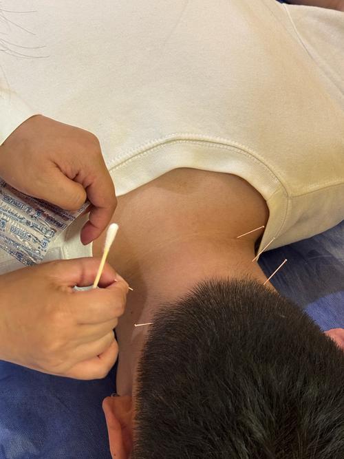 过敏性鼻炎的针灸治疗