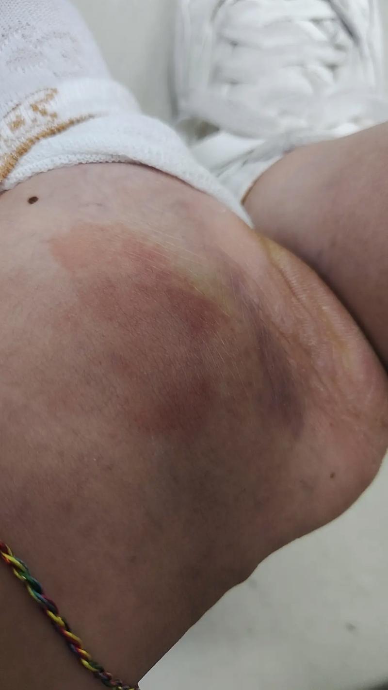 针灸后肿了是什么原因