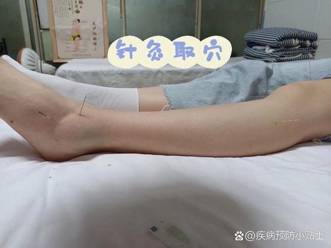 针灸后肿了是什么原因