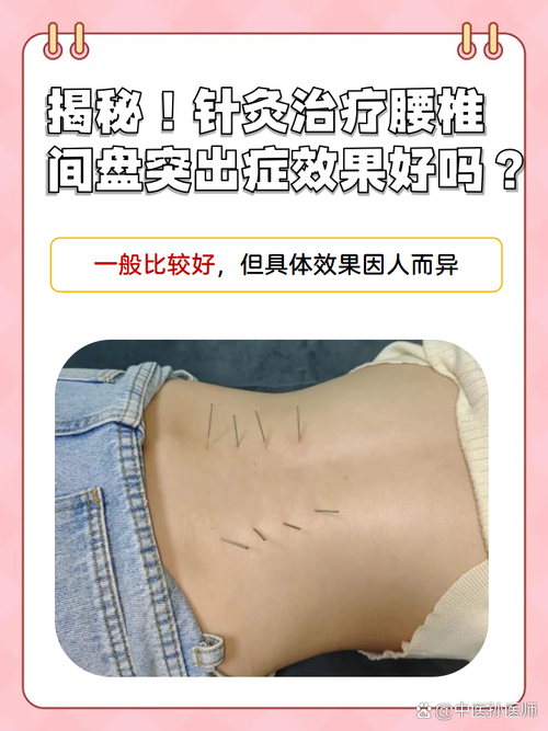 来例假能不能腰椎针灸