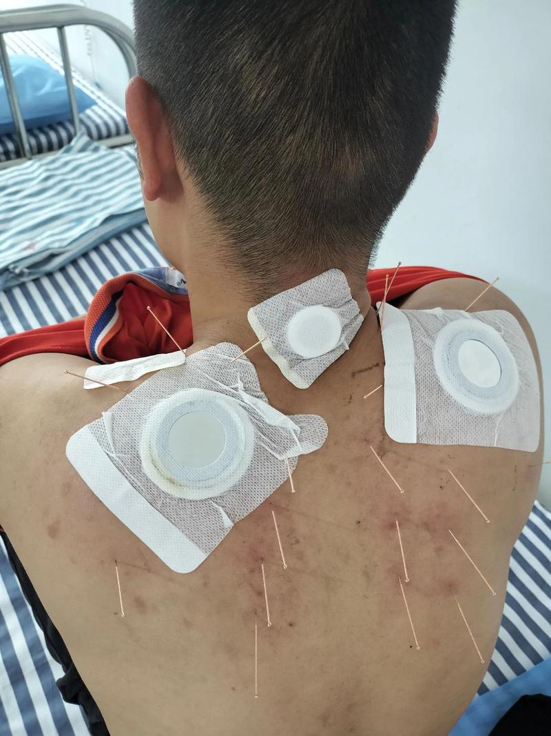 针刀和针灸哪个效果好