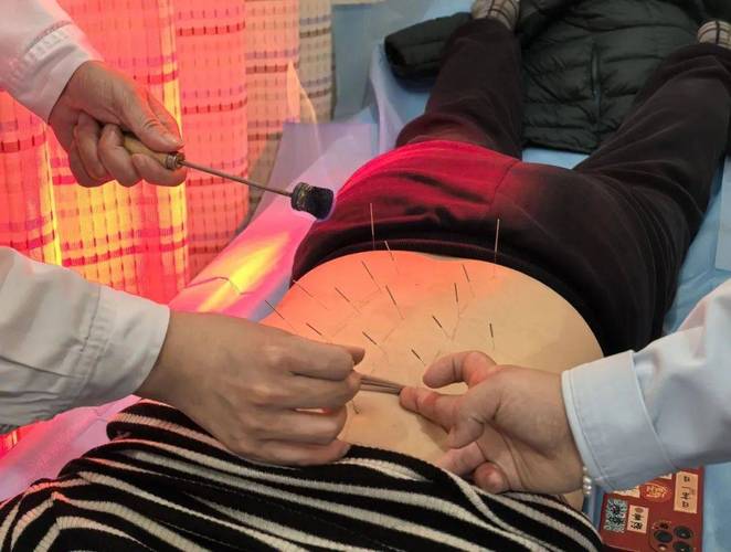 女性臀部针灸视频教程