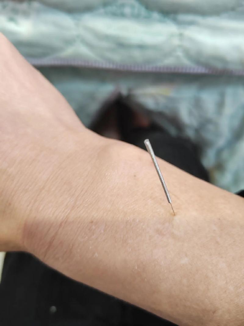 手腕扭伤针灸哪个部位