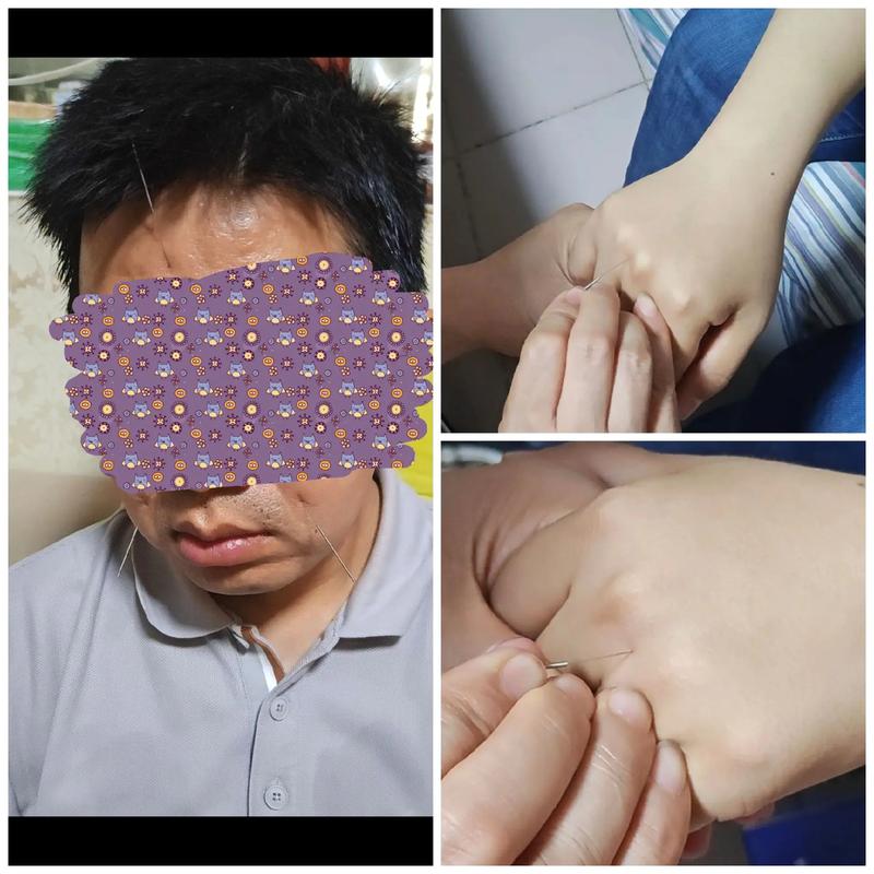 针灸后第二天疼痛加重