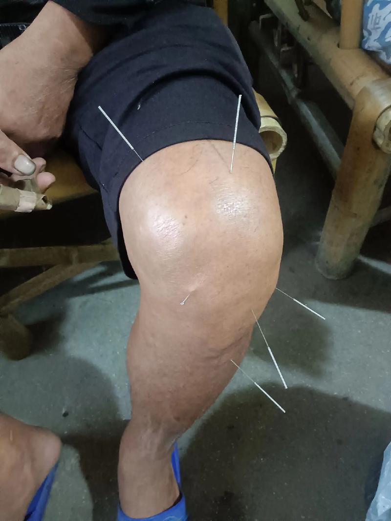 半月板损伤针灸管用吗