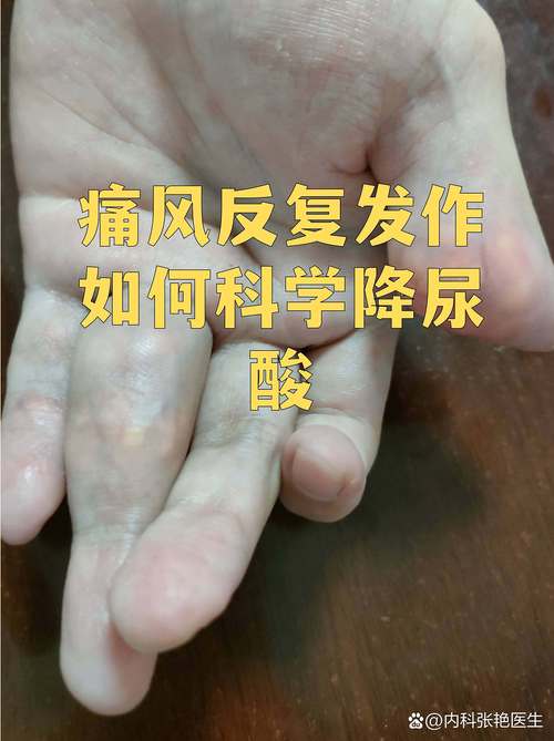 尿酸降下来痛风会好么