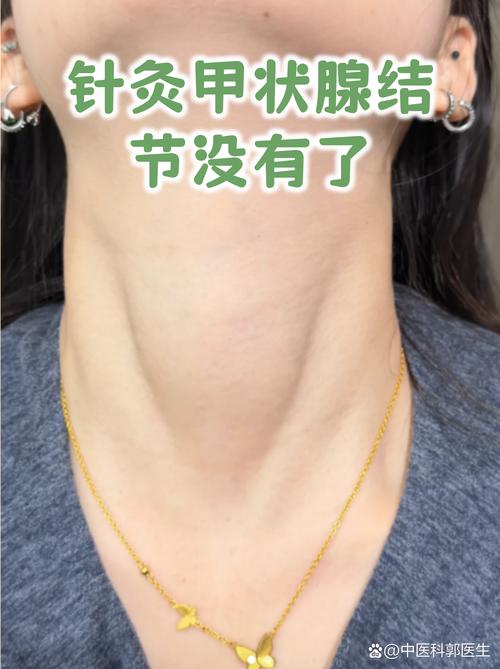 针灸能治甲状腺结节吗