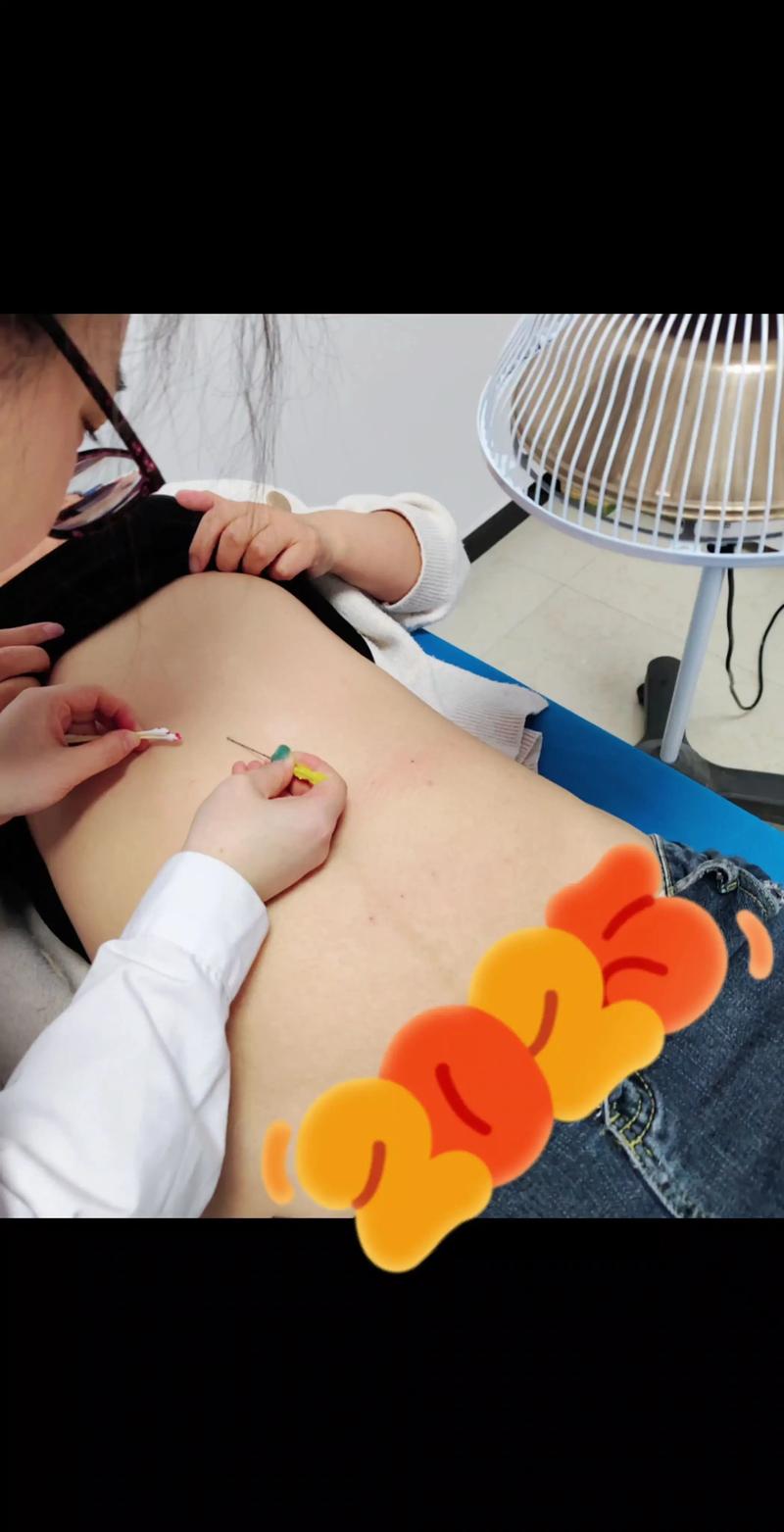 针灸埋线减肥多久见效