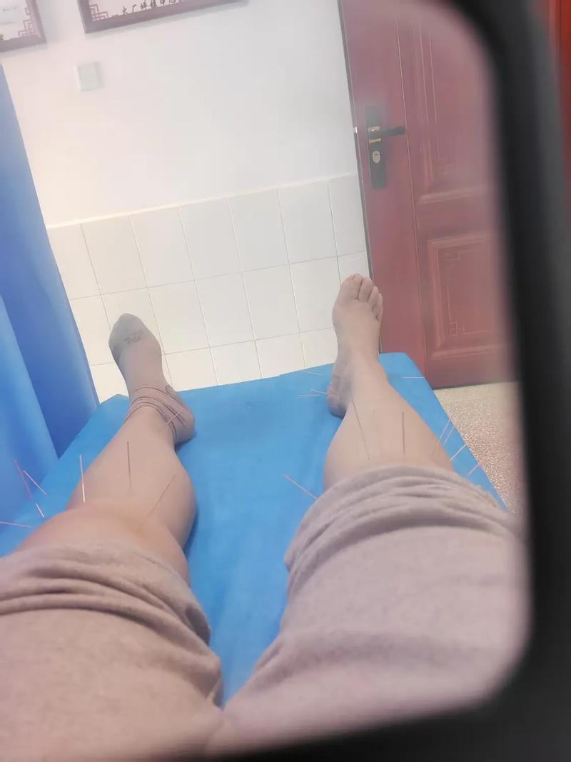 针灸能治疗骨质增生吗