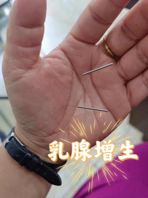 针灸能治疗乳腺增生吗