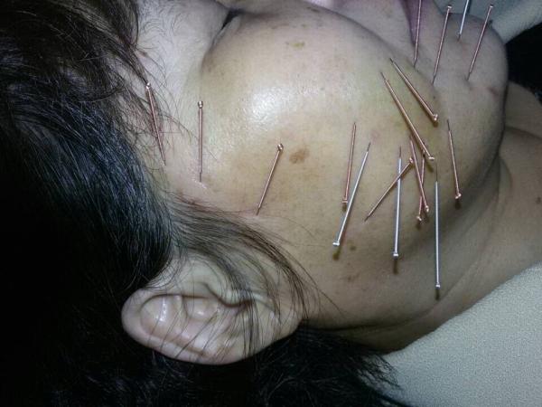 三叉神经痛的针灸治疗