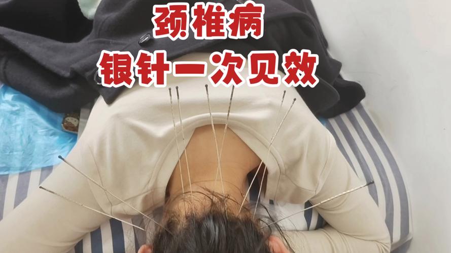 颈椎病头晕可以针灸吗