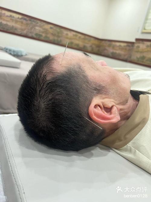 神经性头疼可以针灸吗