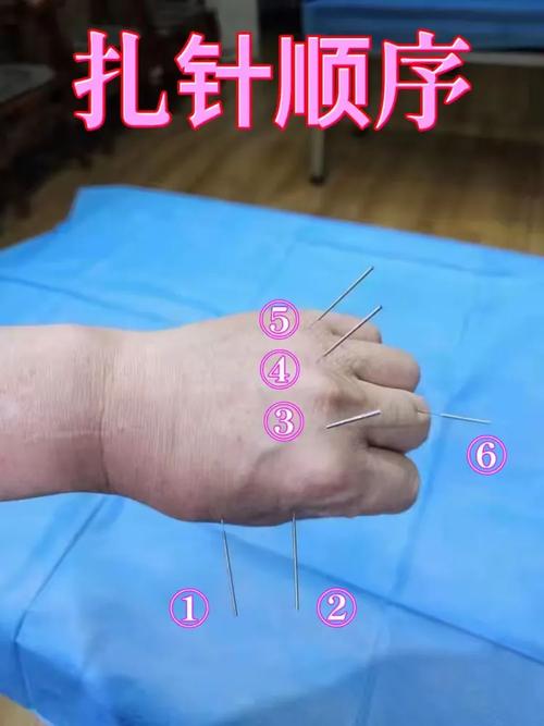 崩漏针灸快速止血方法