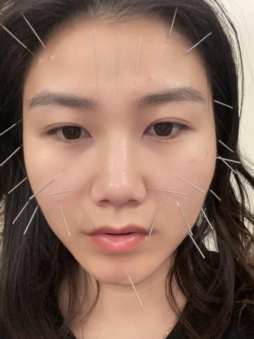 针灸面部提升有效果吗