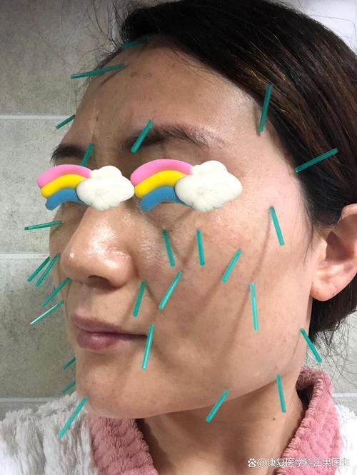 针灸面部提升有效果吗
