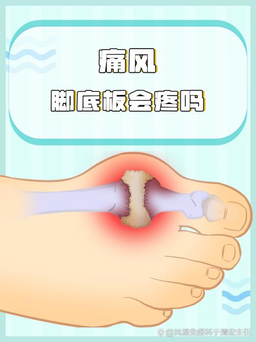 脚关节痛风的治疗方法
